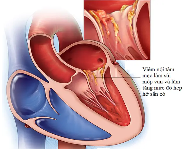 Một số nguyên nhân gây khác gây hẹp van động mạch chủ.webp